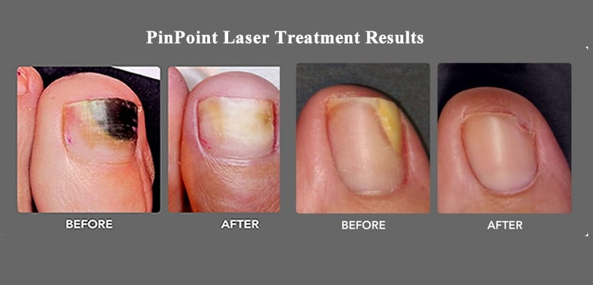 Sunrise Podiatry offering Laser Treatment and Foot Care along with Toenail Fungus Treatment near me.