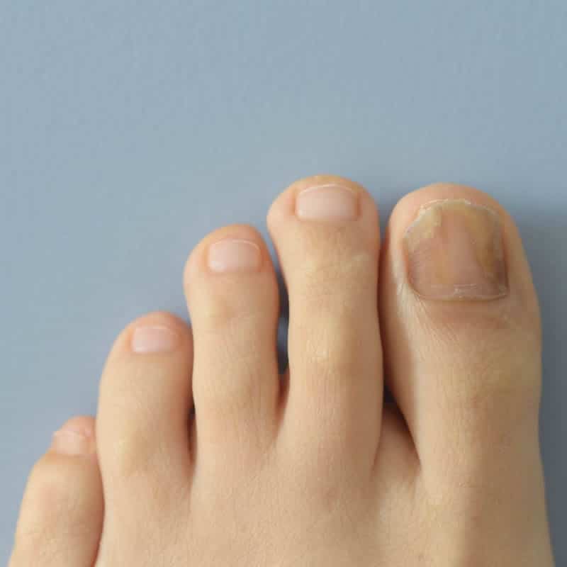 Fungal Toenails Symptoms and Treatment